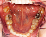 Quel rôle joue le fluorure dans la prévention des caries dentaires?